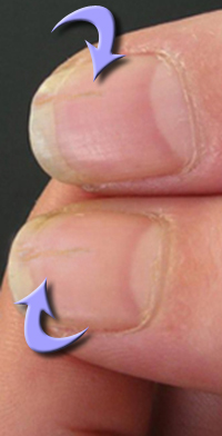 Nageldeformierung